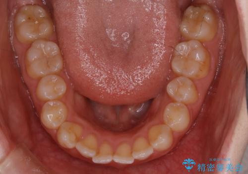 【非抜歯】上下の前歯が噛み合わないオープンバイトの治療の治療前