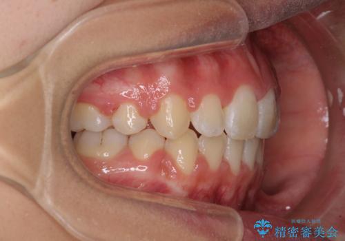 くちばしのように突出した前歯 口元を下げる抜歯矯正の治療後