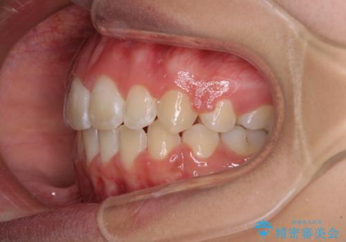 くちばしのように突出した前歯 口元を下げる抜歯矯正の治療後