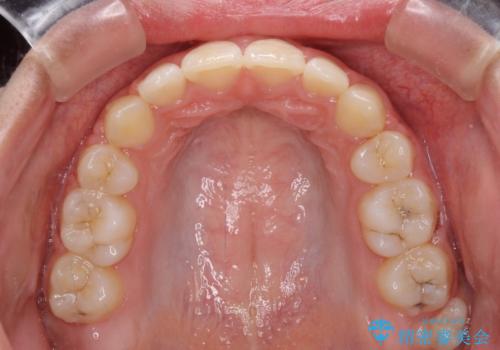 くちばしのように突出した前歯 口元を下げる抜歯矯正の治療後