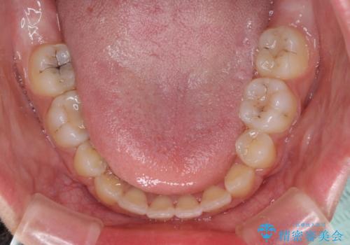 くちばしのように突出した前歯 口元を下げる抜歯矯正の治療後