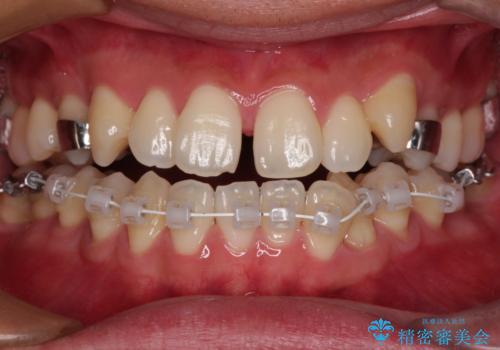 急速拡大装置 歯列弓を拡大して非抜歯ワイヤー矯正の治療中