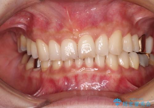 デコボコの歯とむし歯 インビザライン矯正治療とむし歯治療の治療中