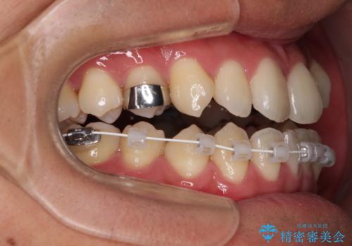 急速拡大装置 歯列弓を拡大して非抜歯ワイヤー矯正の治療中