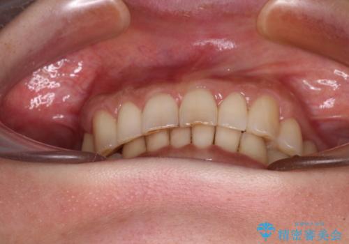 デコボコの歯とむし歯 インビザライン矯正治療とむし歯治療の治療中