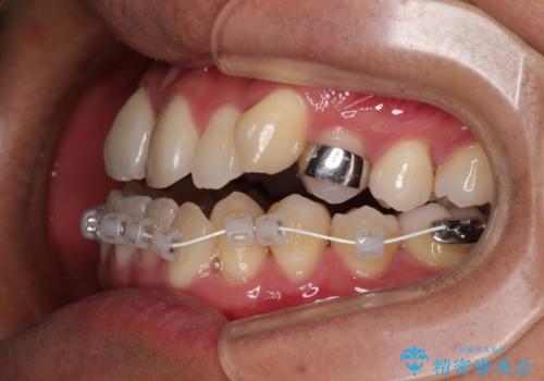 急速拡大装置 歯列弓を拡大して非抜歯ワイヤー矯正の治療中