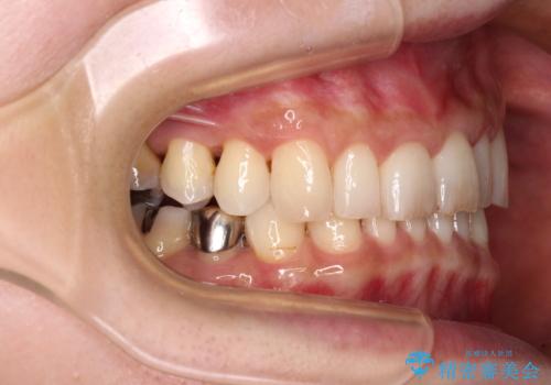 デコボコの歯とむし歯 インビザライン矯正治療とむし歯治療の治療中