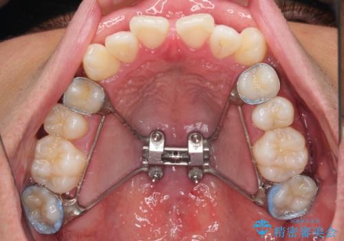 急速拡大装置　歯列弓を拡大して非抜歯ワイヤー矯正の治療中
