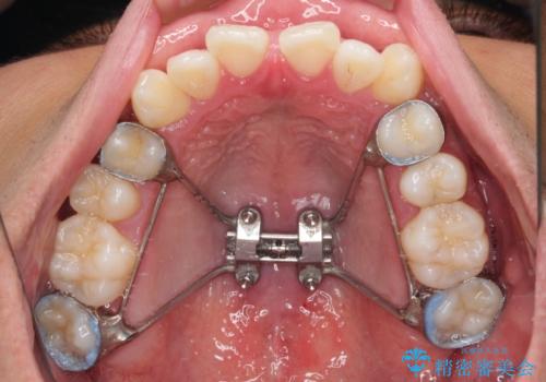 急速拡大装置 歯列弓を拡大して非抜歯ワイヤー矯正の治療中