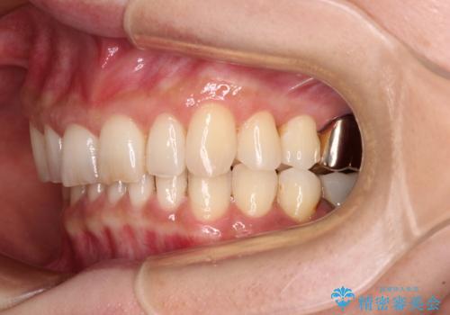 デコボコの歯とむし歯 インビザライン矯正治療とむし歯治療の治療中