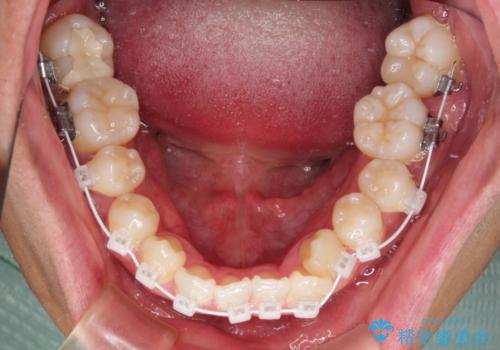 急速拡大装置 歯列弓を拡大して非抜歯ワイヤー矯正の治療中