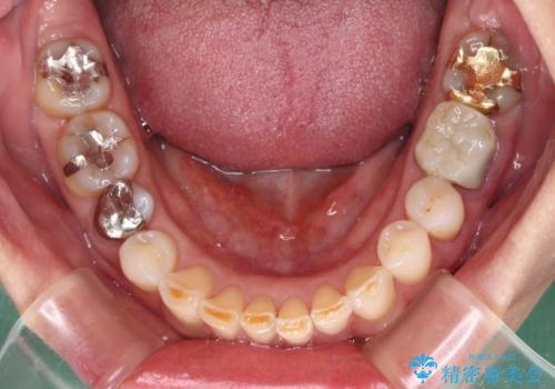 デコボコの歯とむし歯 インビザライン矯正治療とむし歯治療の治療中