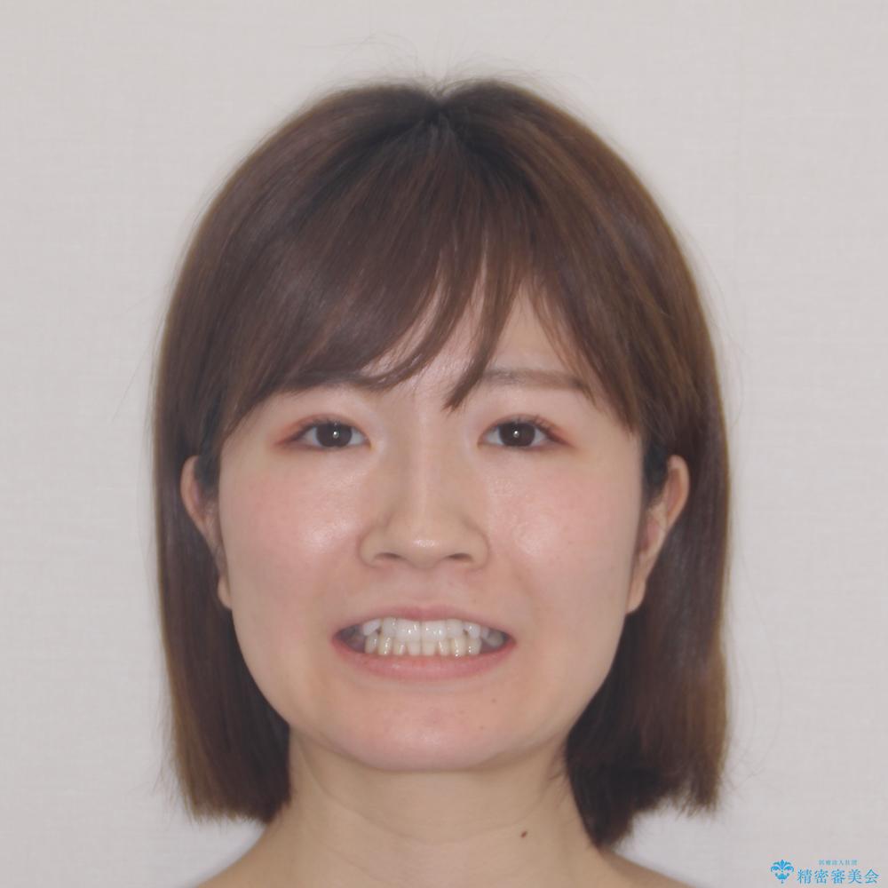 【モニター】インビザラインで気になるデコボコと八重歯をきれいに整えるの治療前(顔貌)