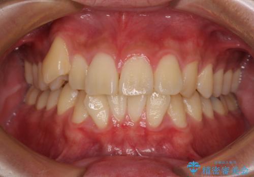 八重歯を無理なくなおしたい ワイヤー装置による非抜歯矯正治療の治療前