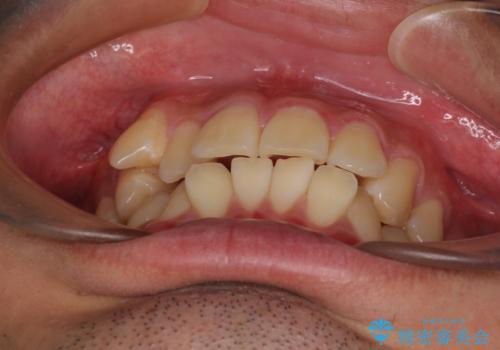 八重歯を無理なくなおしたい ワイヤー装置による非抜歯矯正治療の治療前