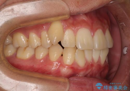 八重歯を無理なくなおしたい ワイヤー装置による非抜歯矯正治療の治療前
