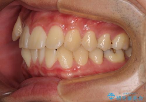 八重歯を無理なくなおしたい ワイヤー装置による非抜歯矯正治療の治療前