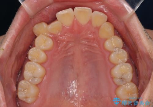 八重歯を無理なくなおしたい ワイヤー装置による非抜歯矯正治療の治療前