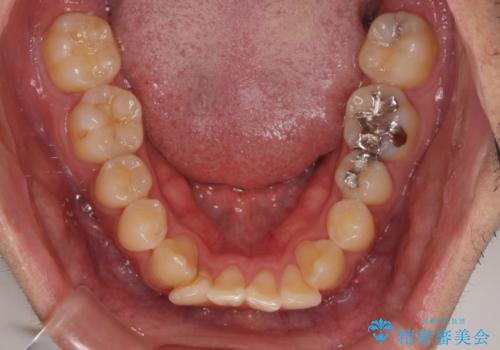 八重歯を無理なくなおしたい　ワイヤー装置による非抜歯矯正治療の治療前