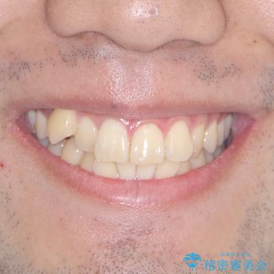 八重歯を無理なくなおしたい ワイヤー装置による非抜歯矯正治療の治療前(顔貌)