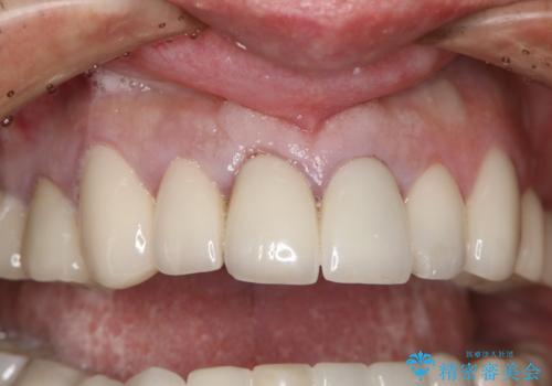 抜歯後早期インプラント埋入で術直後から噛める仮歯が入る!の治療前