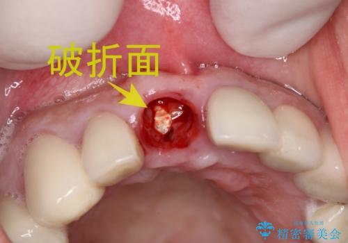 抜歯後早期インプラント埋入で術直後から噛める仮歯が入る!の治療前