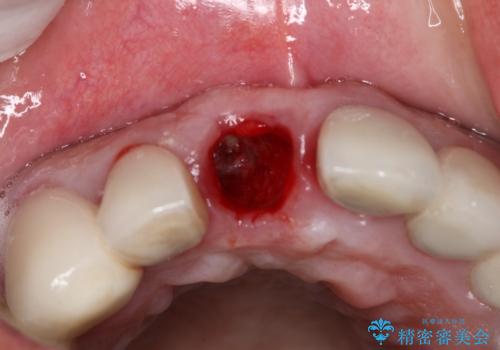 抜歯後早期インプラント埋入で術直後から噛める仮歯が入る!の治療前