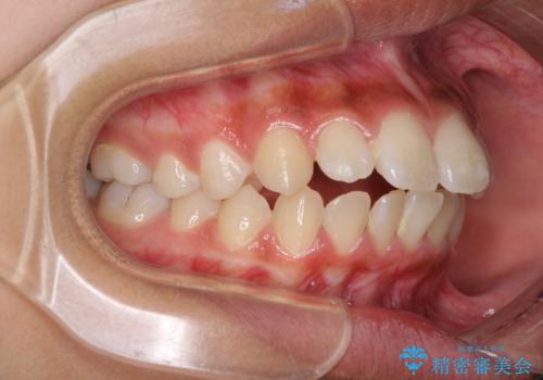 くちばしのように突出した前歯 口元を下げる抜歯矯正の治療前