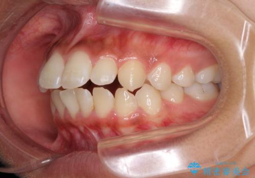 くちばしのように突出した前歯 口元を下げる抜歯矯正の治療前