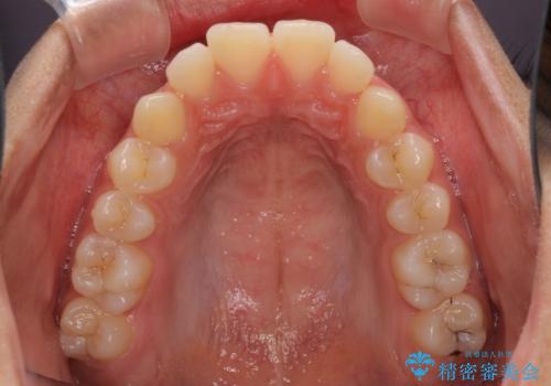 くちばしのように突出した前歯 口元を下げる抜歯矯正の治療前