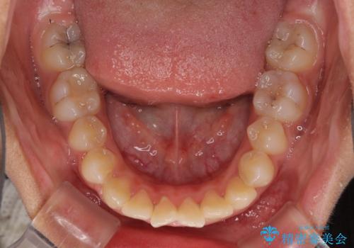 くちばしのように突出した前歯 口元を下げる抜歯矯正の治療前