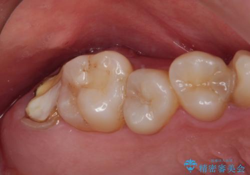 放置したむし歯　抜歯後にインプラントで補綴治療の治療前