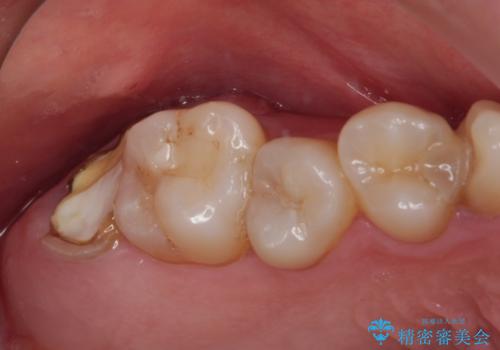 放置したむし歯 抜歯後にインプラントで補綴治療の症例 治療前