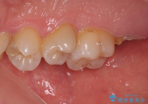 放置したむし歯　抜歯後にインプラントで補綴治療の治療前