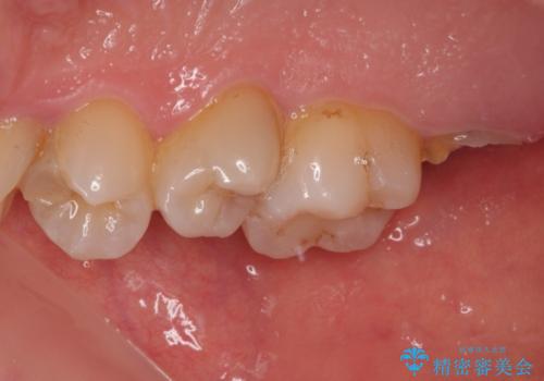放置したむし歯 抜歯後にインプラントで補綴治療の治療前