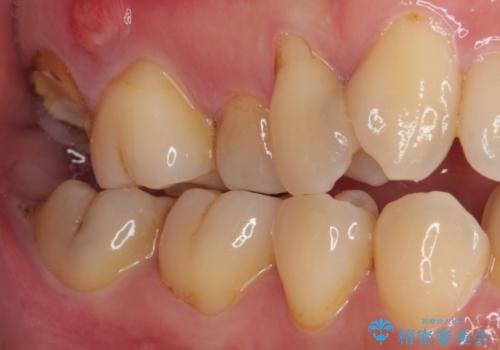 放置したむし歯　抜歯後にインプラントで補綴治療の治療前