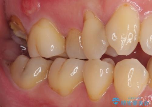 放置したむし歯 抜歯後にインプラントで補綴治療の治療前