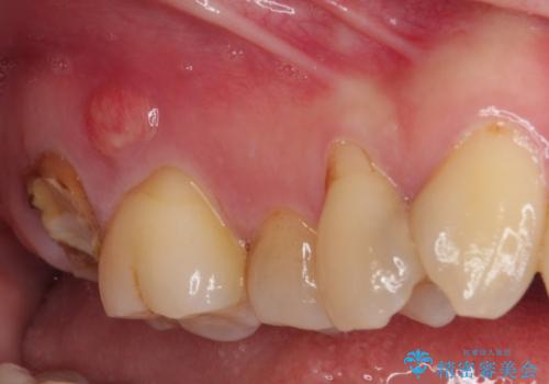放置したむし歯 抜歯後にインプラントで補綴治療の治療前