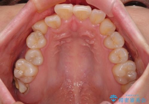 放置したむし歯 抜歯後にインプラントで補綴治療の治療前