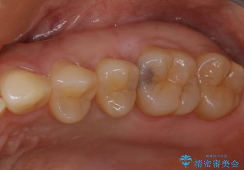 大臼歯 大きな虫歯をセラミックインレーにの治療前
