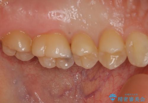 大臼歯 大きな虫歯をセラミックインレーにの治療前