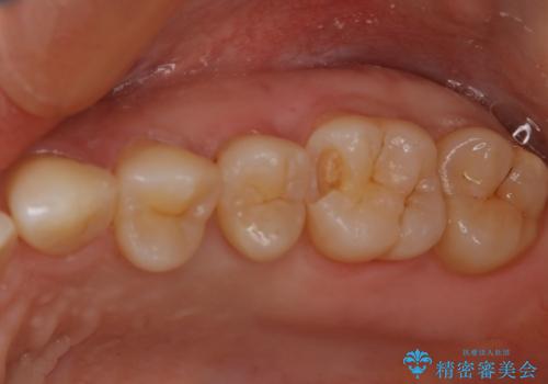 大臼歯 大きな虫歯をセラミックインレーにの治療中