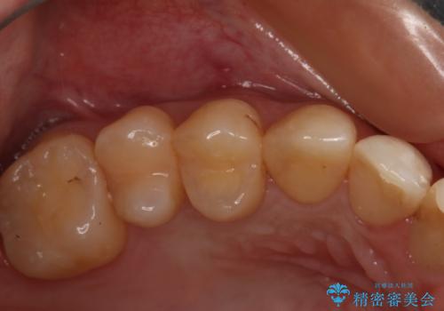 変色した詰め物の再治療 セラミックインレーの治療前