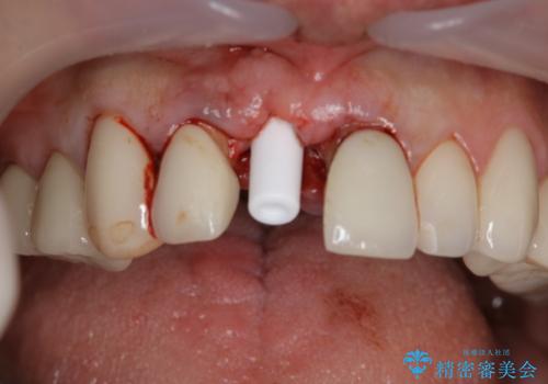 抜歯後早期インプラント埋入で術直後から噛める仮歯が入る!の治療中