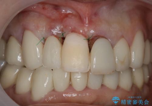 抜歯後早期インプラント埋入で術直後から噛める仮歯が入る!の治療後