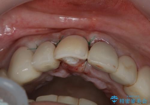 抜歯後早期インプラント埋入で術直後から噛める仮歯が入る!の治療後