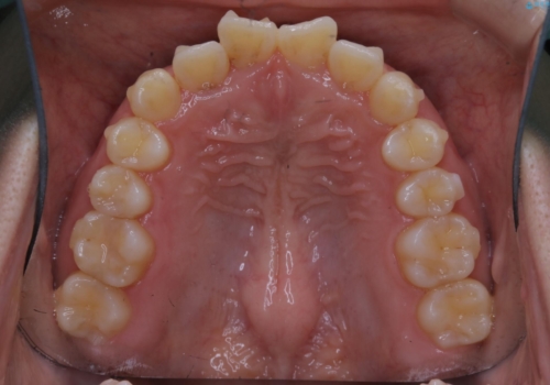 前歯のねじれと深い噛み合わせの改善:インビザライン治療の治療中