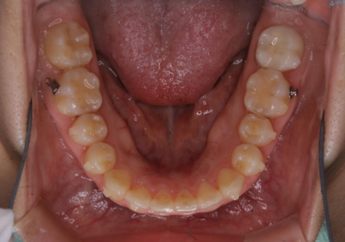 前歯のねじれと深い噛み合わせの改善:インビザライン治療の治療中