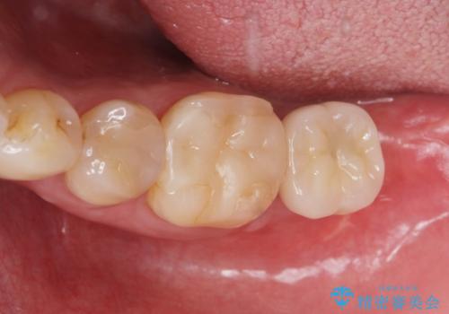 歯からの異臭　虫歯の再発からのインプラント治療の治療後