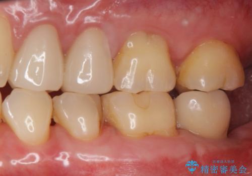 歯からの異臭　虫歯の再発からのインプラント治療の治療後